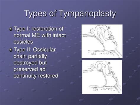 Ppt Tympanoplasty Mastoidectomy Facial Nerve Decompression Powerpoint Presentation Id