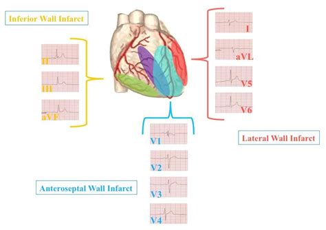 Ekg Leads And Where They Represent You Can Understand A Lot Better