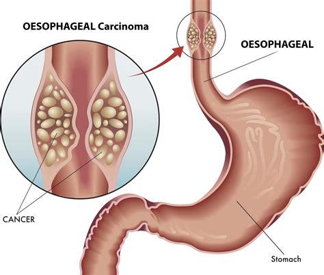 Oesophageal Cancer Singapore Symptoms And Diagnosis Gutcare