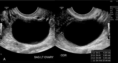 Ultrasound Of Common Adnexal Cysts Ovarian Cyst Ultrasound Cysts Sexiz Pix