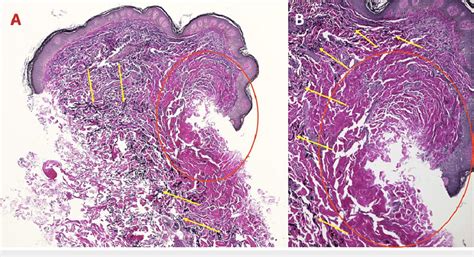 Vvg Stained Sections Of An Atrophic Dermatofibroma On The Left Shoulder Download Scientific