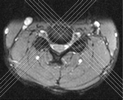 Figure 2 From Coronal Oblique Orientation Offers Improved Visualization