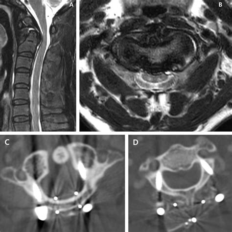 Sagittal A And Axial B Mr Images Showing Nonunion Of The Odontoid