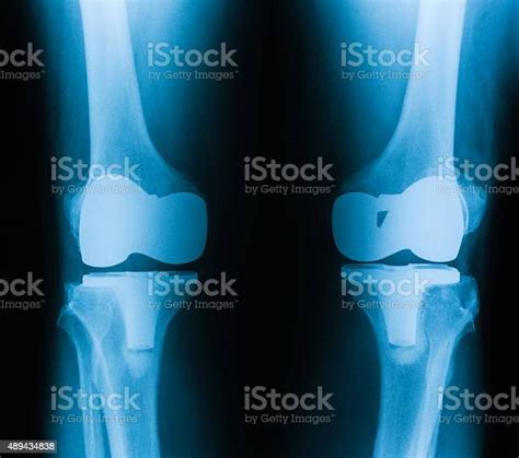 Bilateral Knee Xray Showing Knee Total Hip Replacements Stock Photo