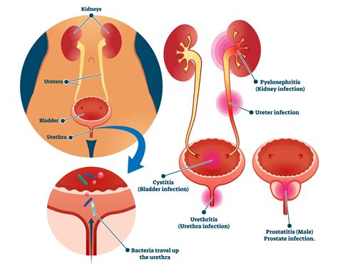 Myths About Urinary Tract Infections Debunked