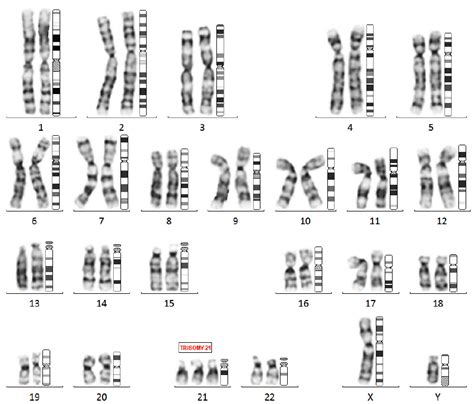 shows g banded karyotype of male down syndrome with 47 xy 21 download scientific diagram