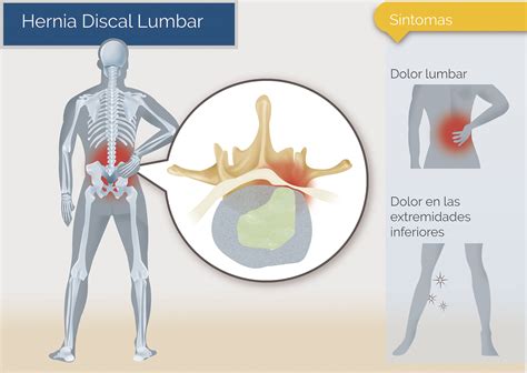 Hernia Discal Lumbar Unidad De Neurocirug A De La Torre