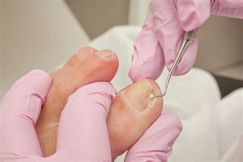 How to cut an ingrown toenail: Home and medical procedures