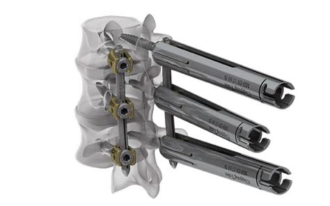 Spineart Romeo® 2 Posterior Osteosynthesis Pedicle Screw System