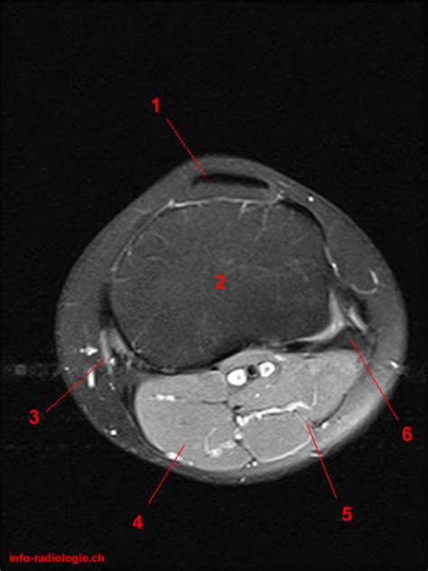 Sagittal images are useful for secondary look at the meniscal horns and roots. MRT der Knie: T2-gewichtete, FATSAT, axialen Schnitte