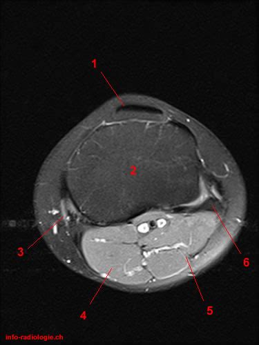 Master leg and knee anatomy using our topic page. Atlas of Knee MRI Anatomy - W-Radiology