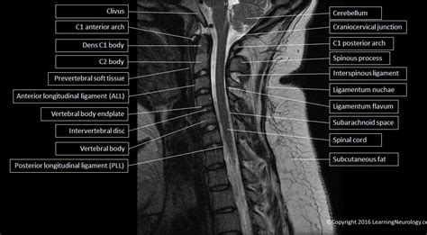 Sagittal Mri C Spine T2 With Structures Labeled Mri Study Radiologic