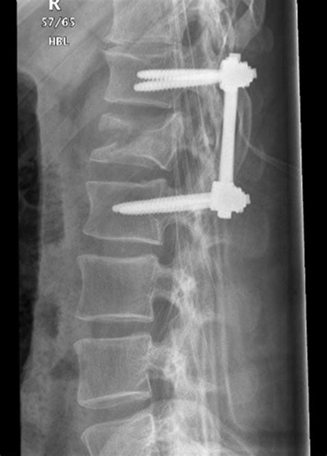 Diagnosis Of Vertebral Fractures In Post Ictal Patients Emergency