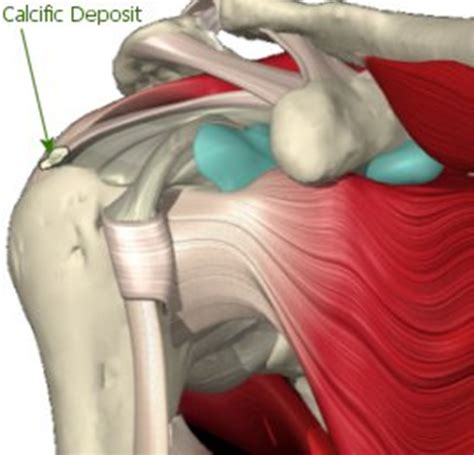 Calcific Tendonitis Brisbane Knee And Shoulder Clinic Dr