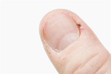 Best Way To Treat An Infected Hangnail Share News About Nail