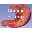 Chronic Gastritis Definition N HG