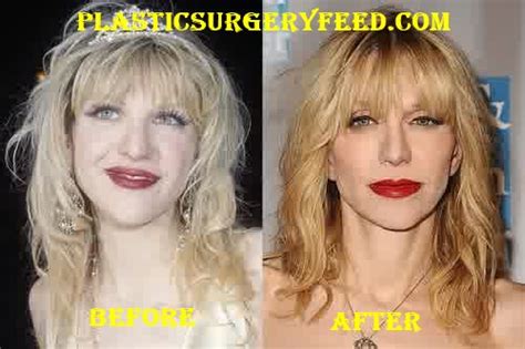 Courtney Love Plastic Surgery Plastic Surgery Feed