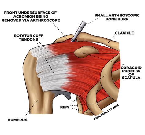 Mr Paul Jarrett Shoulder Impingement Bursitis Murdoch Orthopaedic