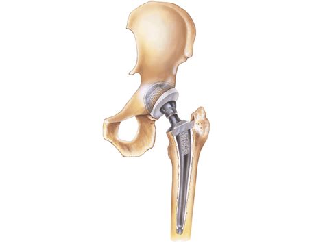 Hip Replacement - Procedure Types, Recovery Time, & Risks