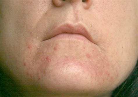 Staph Infection Rash On Face