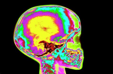 Coloured X Ray Of Childs Skull And Tooth Eruption Photograph By Mehau