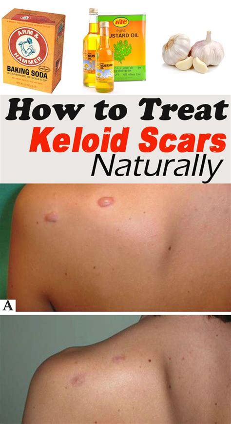 How To Treat Keloids Home Remedy