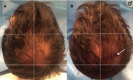 The hair stem cell transplantation (hst) method involves removing the entire hair follicle, as well as a number of stem cells in the donor area. Hair Loss Cure 2020 | Page 3 of 241 | Hair loss cure news ...