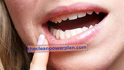في أي نقص فيتامين يظهر جرح الفم القلاع ، هل هو معدي؟ العلاجات العشبية