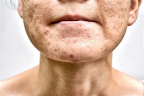 Sebum And The Sebaceous Glands Facty Health