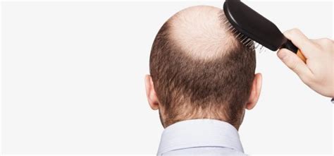 The healing process takes its natural course and on average a person will start to visibly appreciate results six months after initiating treatment and maximal results after a year. ANTI DHT Hair Loss Treatment Malaysia [How To Combat DHT ...