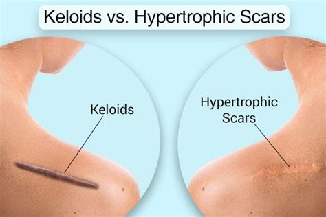 The Difference Between Keloid Hypertrophic Scars
