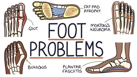 Common Foot Problems Youtube