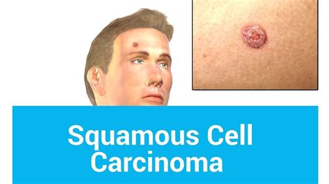 Pictures Of Squamous Cell Carcinoma Youtube