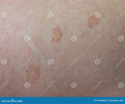 Tinea Versicolor Or Pityriasis Alba In Neck Of Southeast Asian Man
