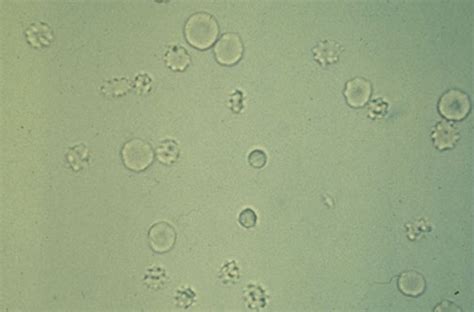 38 yrs old male asked about rbc in urine, 1 doctor answered this and 9756 people found it useful. Urinalysis