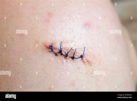 Sewn Medical Suture On Human Body Stitched Wound And Medical Suture