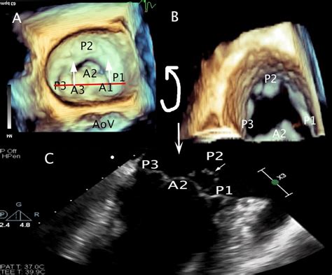 Part 1 Tee Evaluation Of The Mitral Valve Congenital Cardiac
