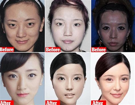 Photos Chinese Women Getting Plastic Surgery So Drastic They Cant Get