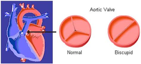 Bicuspid Aortic Valve Symptoms Diagnosis And Treatments Singhealth