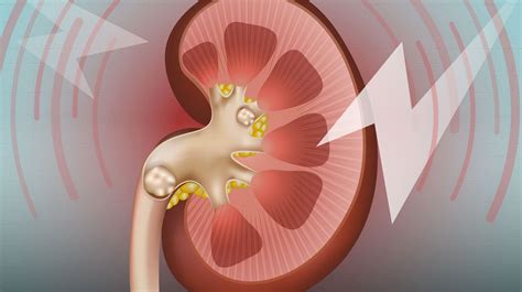 Kidney Stones A Marker Of Overall Kidney Health News Uab