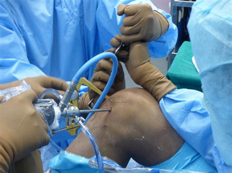 Acl Reconstruction Knee Arthroscopy Dr Sujit Jos Docjointsdr Sujit Josjoint Surgeon