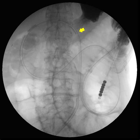 A Newly Developed Nasojejunal Tube Was Inserted Via The Gastrostomy