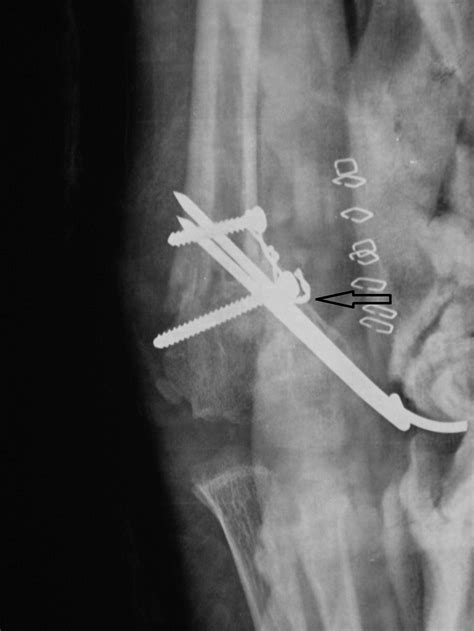 Triple Modified French Osteotomy A Possible Answer To Cubitus Varus