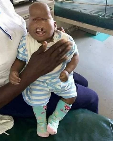 Baby Born With Severe Facial Deformities In Kenya Shunned By Parents