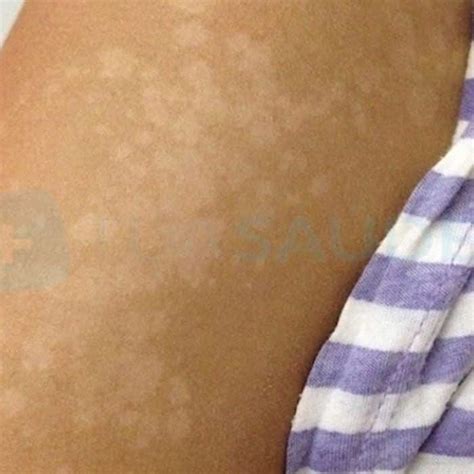 Manchas brancas na pele o que são Tipos e tratamentos