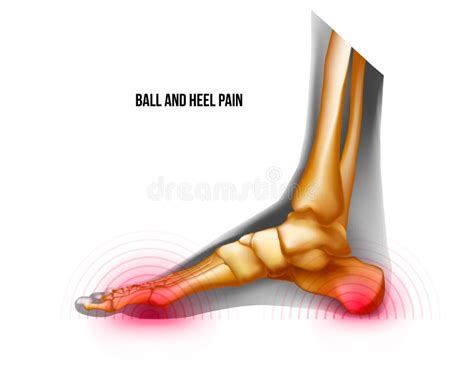 Ball And Heel Of Foot Pain Bones Skeleton Realistic Anatomy