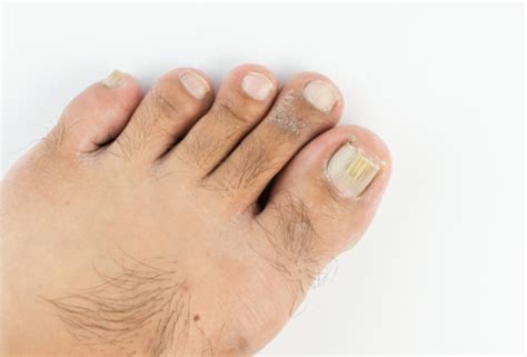 Thick Toenails Symptoms Causes And Treatment