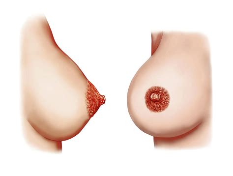 Postpartum Breasts Photograph By Asklepios Medical Atlas The Best