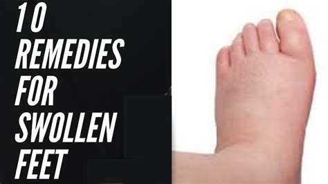 10 Ways To Reduce Swollen Feet Home Remedies For Swelling In Feet Youtube