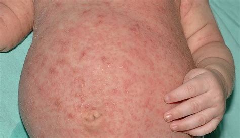 Scabies Treatment Guidelines